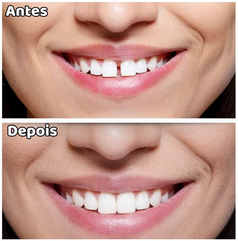 Diastemas (espaços entre os dentes)
