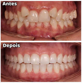 Sobremordida (mordida profunda)